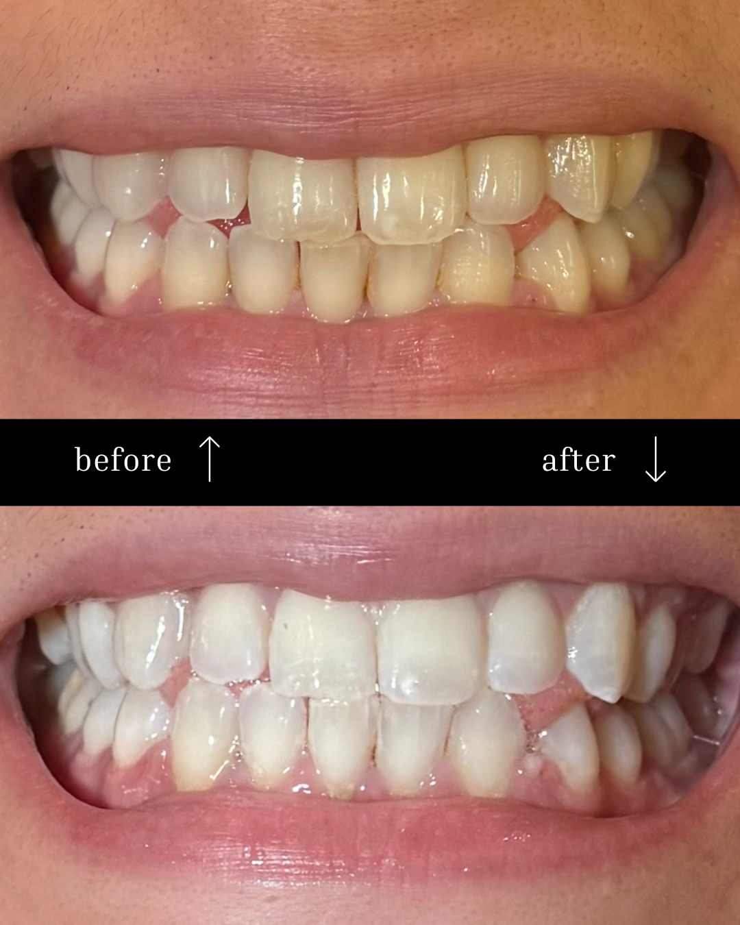 Frosted Teeth Whitening